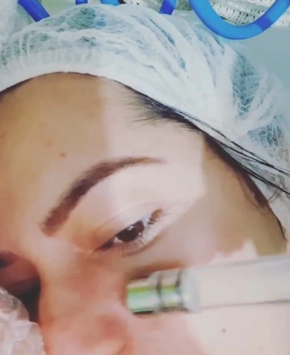 Peeling Diamante esfoliação profunda